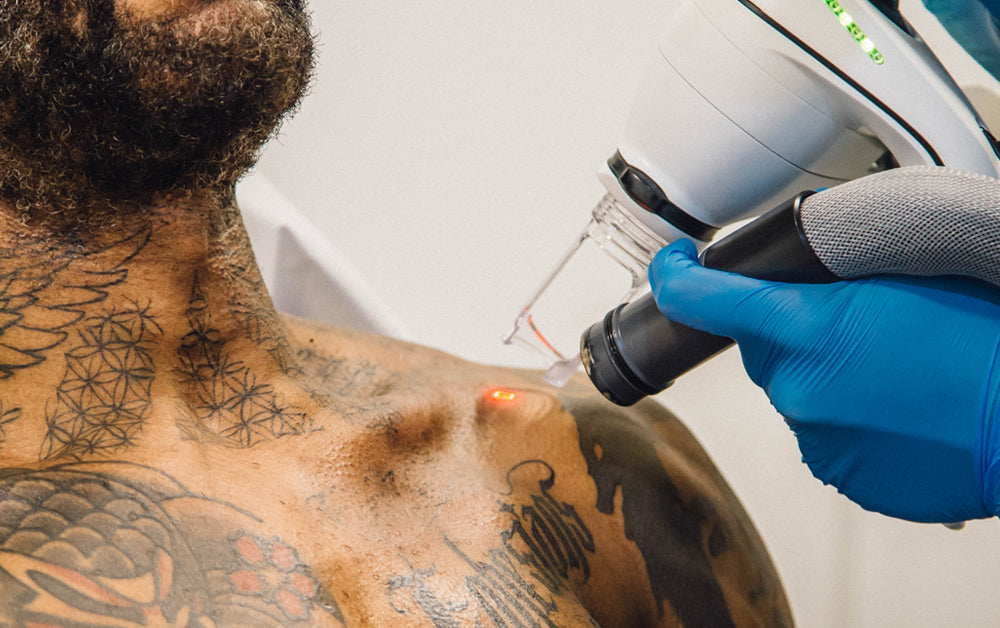 Complex & large tattoos can affect how much laser tattoo removal costs.