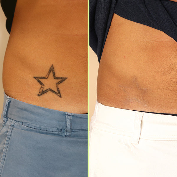 Laser tattoo removal in action