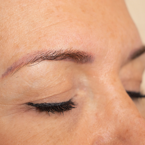 Start your eyebrow tattoo removal today.