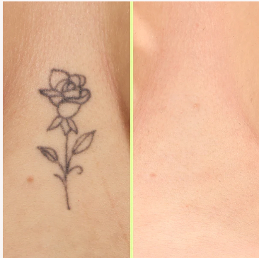Rose tattoo removal results