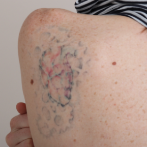 At the start of treatment