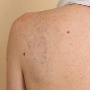 Throughout treatment