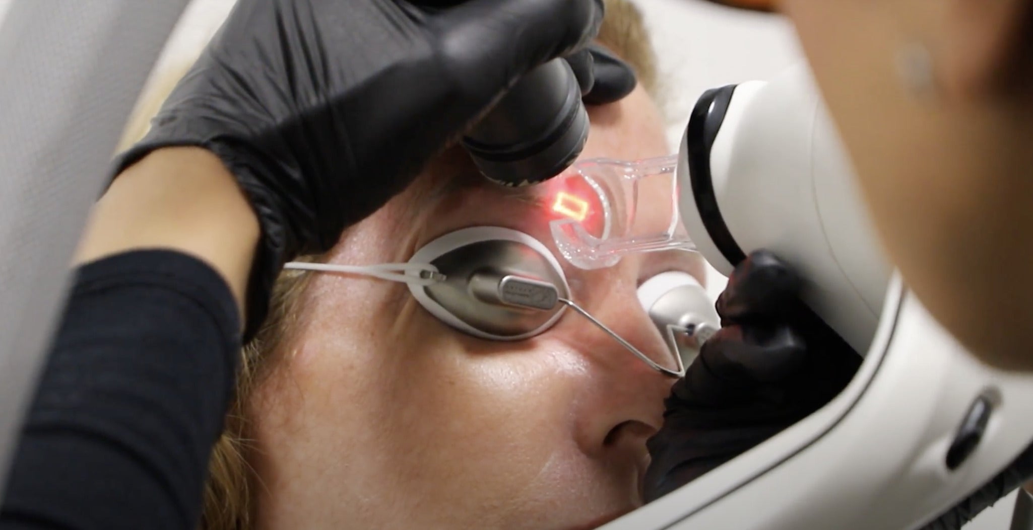 microblading removal treatment