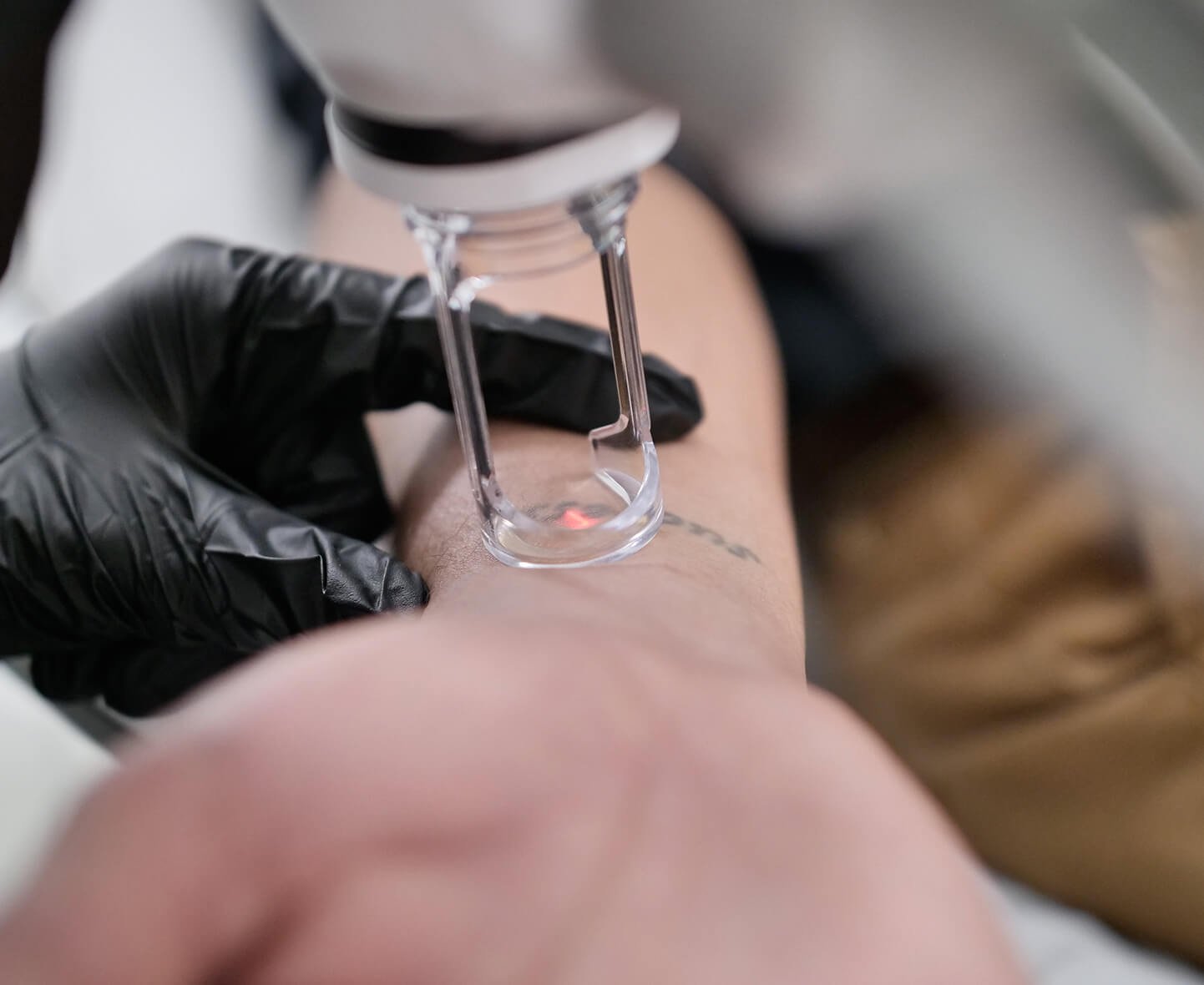 Lightsense tattoo removal laser with effective results