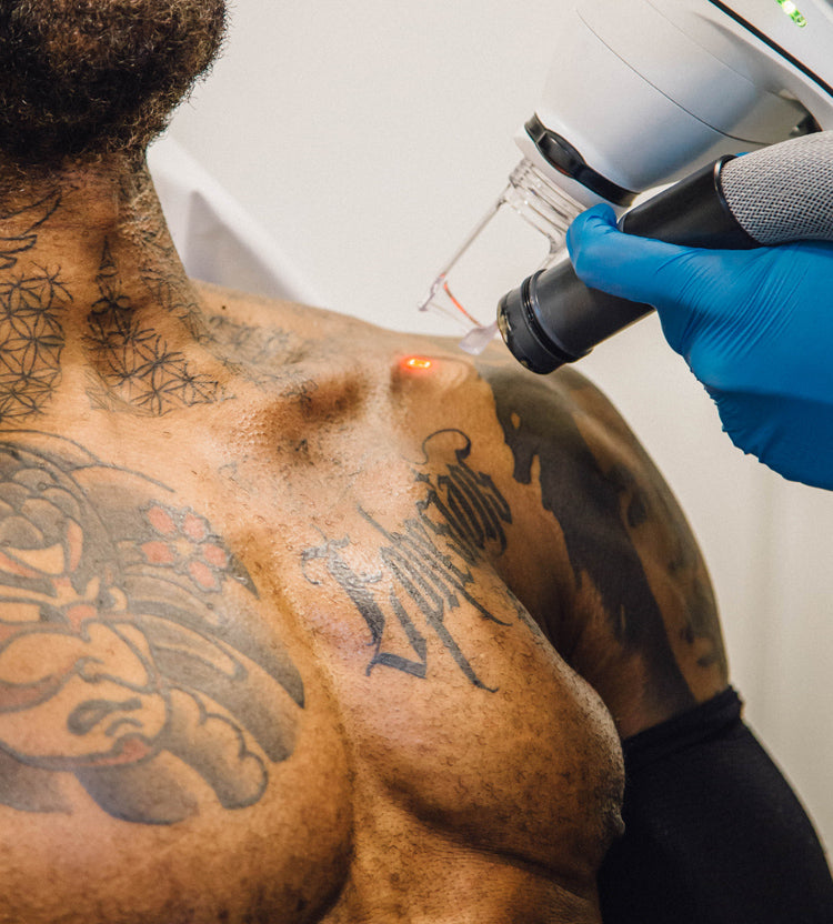 Laser tattoo removal process.