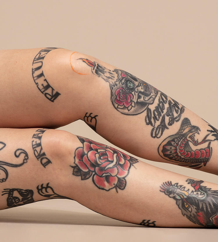 Completely healed after the removal if an unwanted tattoo.